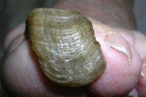 patologia-unghie-milano-copy